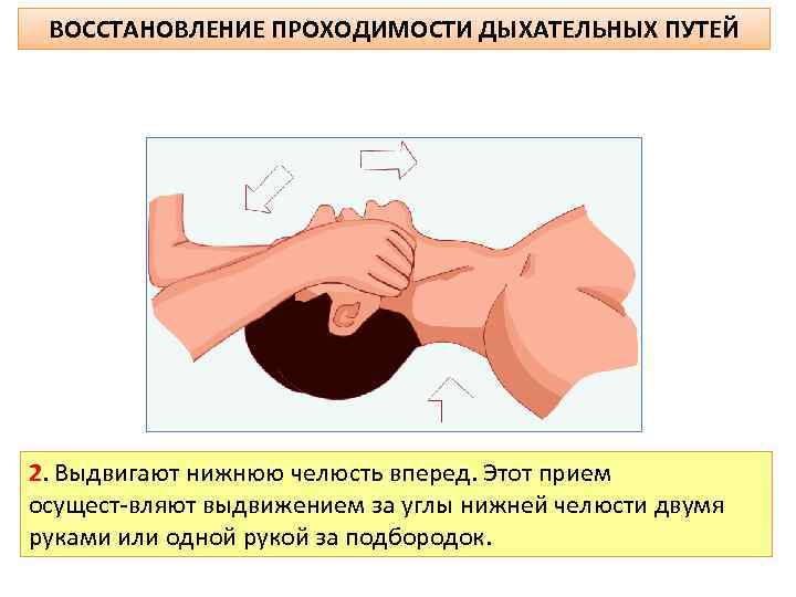 ВОССТАНОВЛЕНИЕ ПРОХОДИМОСТИ ДЫХАТЕЛЬНЫХ ПУТЕЙ 2. Выдвигают нижнюю челюсть вперед. Этот прием осущест вляют выдвижением