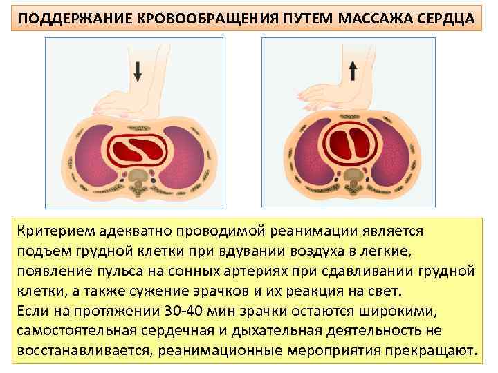 ПОДДЕРЖАНИЕ КРОВООБРАЩЕНИЯ ПУТЕМ МАССАЖА СЕРДЦА Критерием адекватно проводимой реанимации является подъем грудной клетки при