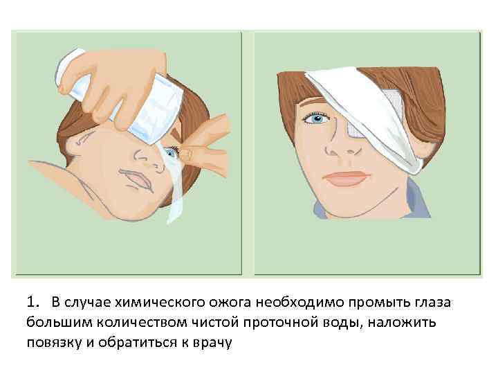 1. В случае химического ожога необходимо промыть глаза большим количеством чистой проточной воды, наложить