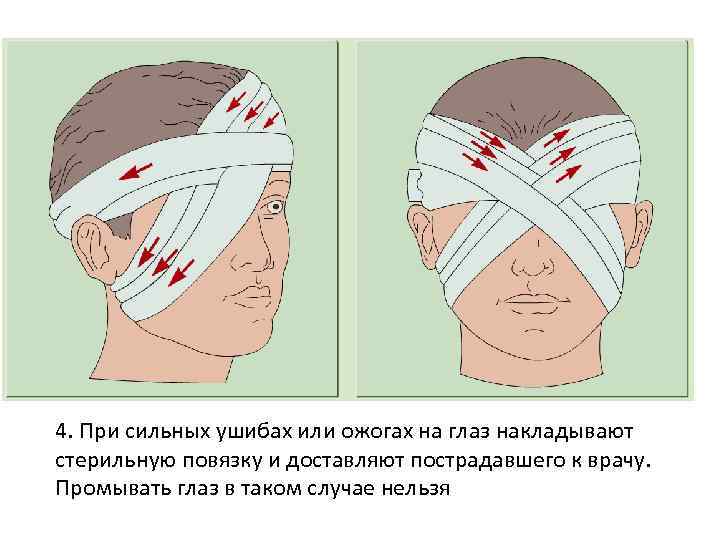 Повязка накладывается при повреждении затылка. Бинокулярная повязка на оба глаза. Наложение повязки на глаз. Повязка при травме глаза. Наложение асептической повязки на глаз.