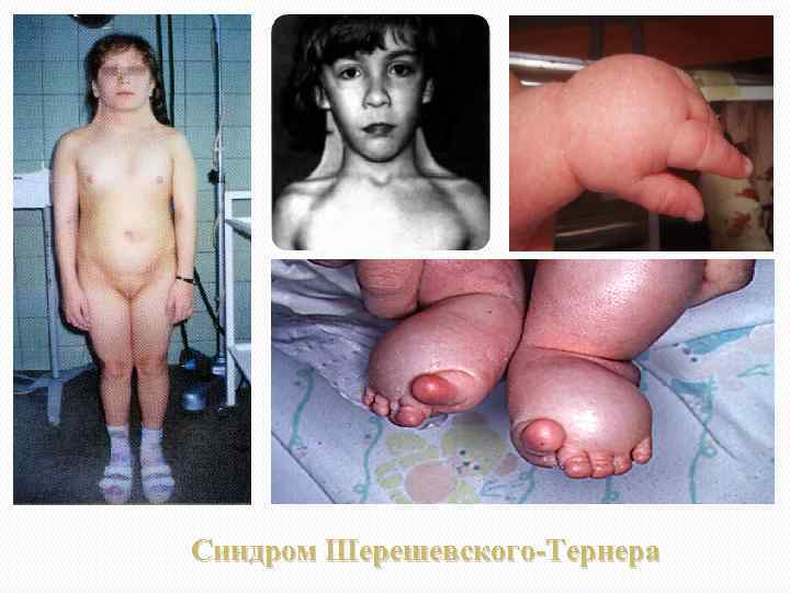 Синдром Шерешевского-Тернера 