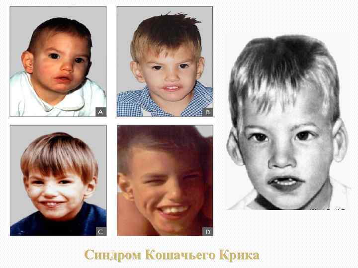 Синдром Кошачьего Крика 