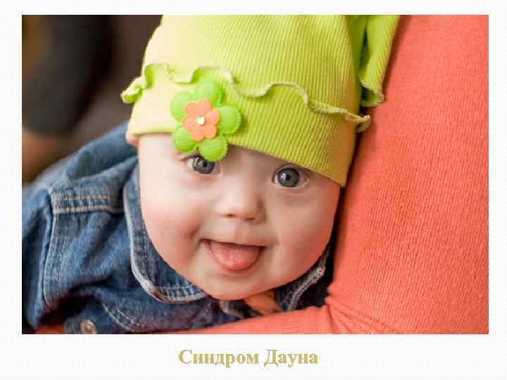 Синдром Дауна 