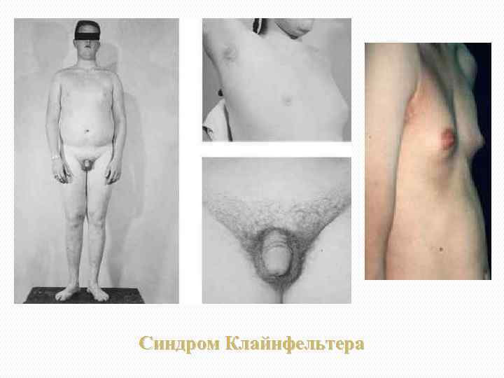 Синдром Клайнфельтера 