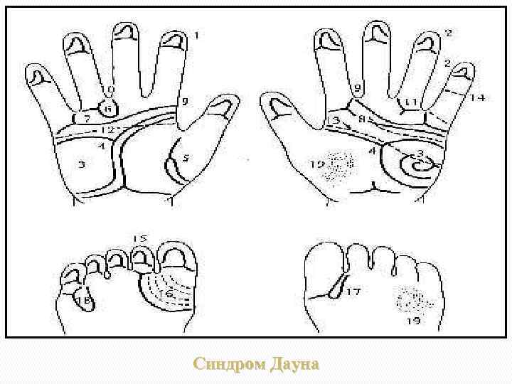 Синдром Дауна 