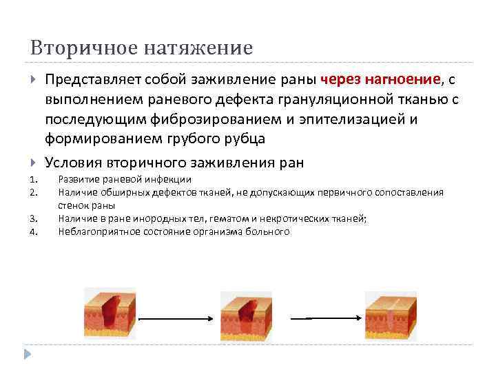 Вторичное натяжение 1. 2. 3. 4. Представляет собой заживление раны через нагноение, с выполнением