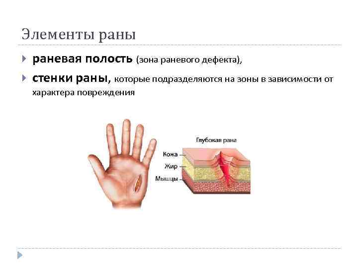 Элементы раневая полость (зона раневого дефекта), стенки раны, которые подразделяются на зоны в зависимости