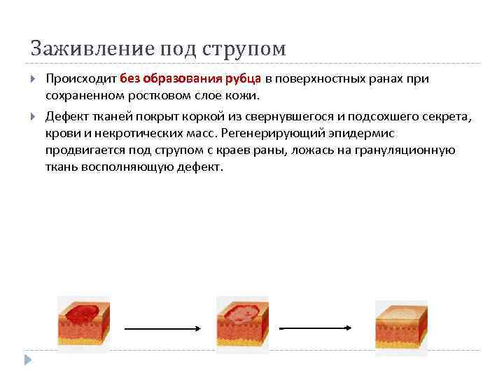 Заживление под струпом Происходит без образования рубца в поверхностных ранах при сохраненном ростковом слое