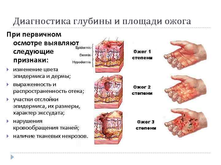 Диагностика глубины и площади ожога При первичном осмотре выявляют следующие признаки: изменение цвета эпидермиса