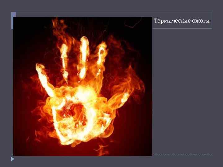 Термические ожоги 