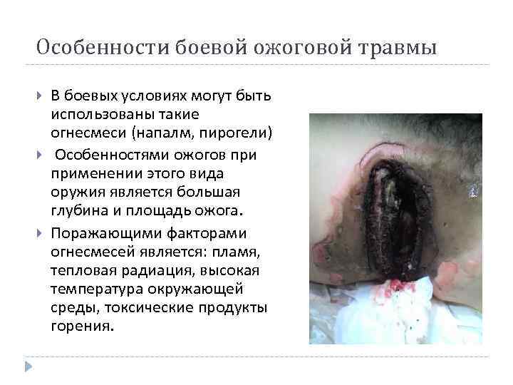 Особенности боевой ожоговой травмы В боевых условиях могут быть использованы такие огнесмеси (напалм, пирогели)