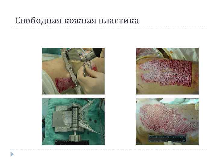 Свободная кожная пластика 