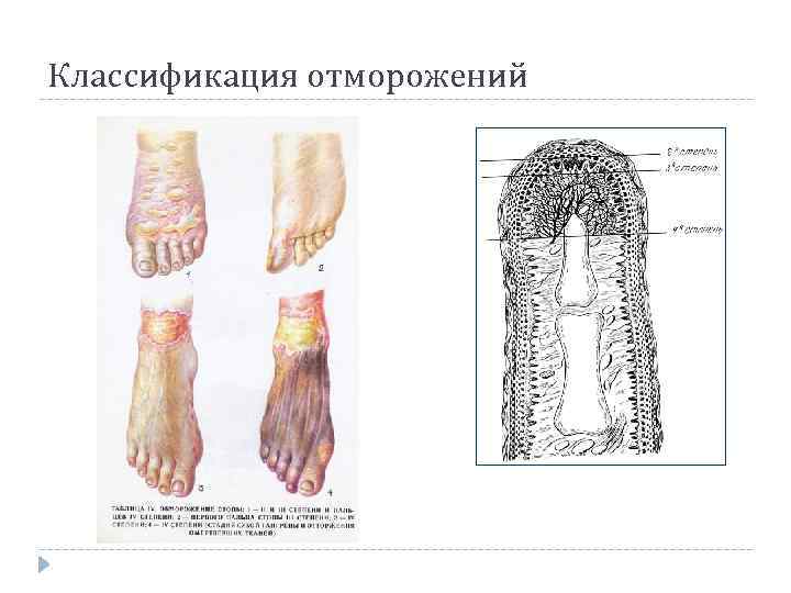 Классификация отморожений 