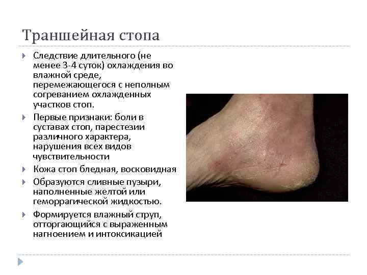 Траншейная стопа Следствие длительного (не менее 3 -4 суток) охлаждения во влажной среде, перемежающегося