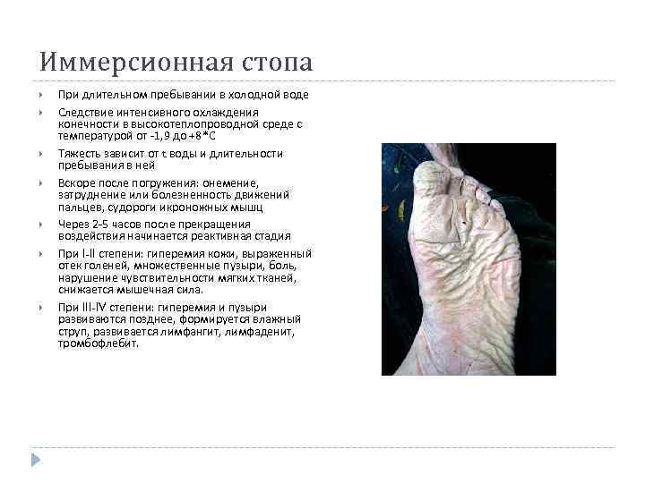 Иммерсионная стопа При длительном пребывании в холодной воде Следствие интенсивного охлаждения конечности в высокотеплопроводной