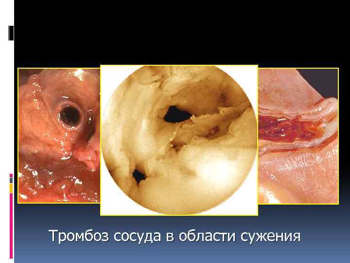 Тромбоз сосуда в области сужения 