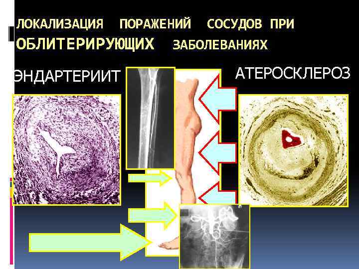 ЛОКАЛИЗАЦИЯ ПОРАЖЕНИЙ СОСУДОВ ПРИ ОБЛИТЕРИРУЮЩИХ ЗАБОЛЕВАНИЯХ ЭНДАРТЕРИИТ АТЕРОСКЛЕРОЗ 