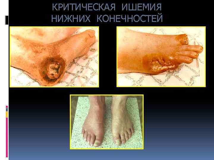 КРИТИЧЕСКАЯ ИШЕМИЯ НИЖНИХ КОНЕЧНОСТЕЙ 