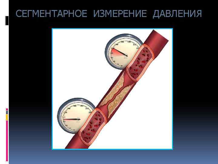СЕГМЕНТАРНОЕ ИЗМЕРЕНИЕ ДАВЛЕНИЯ 