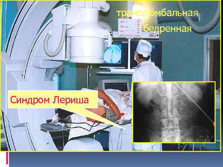 транслюмбальная ИНСТРУМЕНТАЛЬНЫЕ МЕТОДЫ ДИАГНОСТИКИ бедренная АНГИОГРАФИЯ Синдром Лериша 