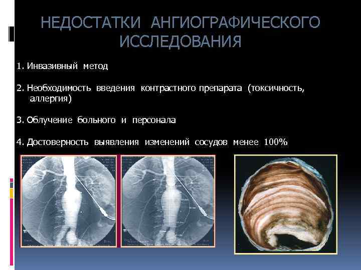 НЕДОСТАТКИ АНГИОГРАФИЧЕСКОГО ИССЛЕДОВАНИЯ 1. Инвазивный метод 2. Необходимость введения контрастного препарата (токсичность, аллергия) 3.