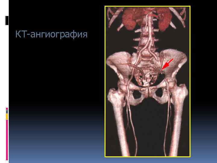 КТ-ангиография 