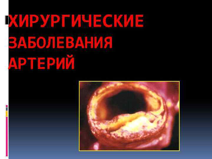 ХИРУРГИЧЕСКИЕ ЗАБОЛЕВАНИЯ АРТЕРИЙ 