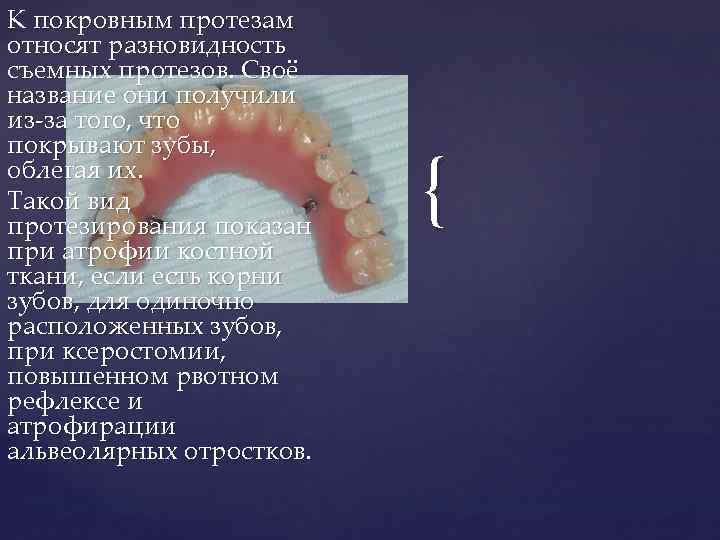 К покровным протезам относят разновидность съемных протезов. Своё название они получили из-за того, что