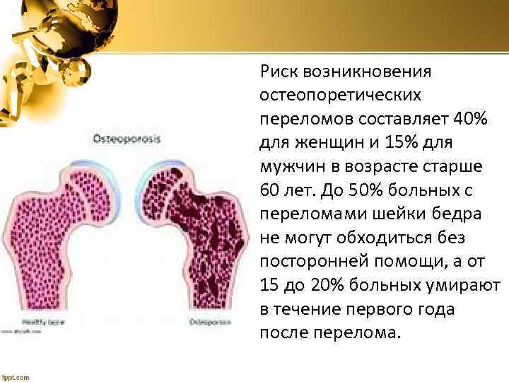 Риск возникновения остеопоретических переломов составляет 40% для женщин и 15% для мужчин в возрасте