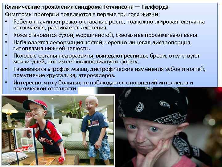 Клинические проявления синдрома Гетчинсона — Гилфорда Симптомы прогерии появляются в первые три года жизни: