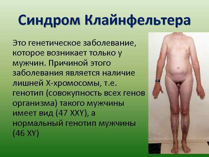 Синдром Клайнфельтера Это генетическое заболевание, которое возникает только у мужчин. Причиной этого заболевания является