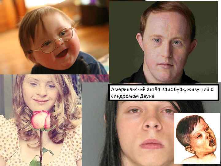 Американский актёр Крис Бурк, живущий с синдромом Дауна 