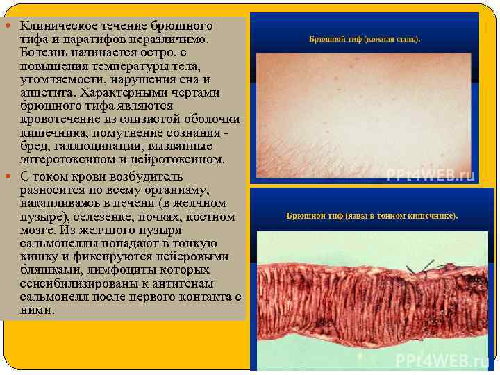  Клиническое течение брюшного тифа и паратифов неразличимо. Болезнь начинается остро, с повышения температуры