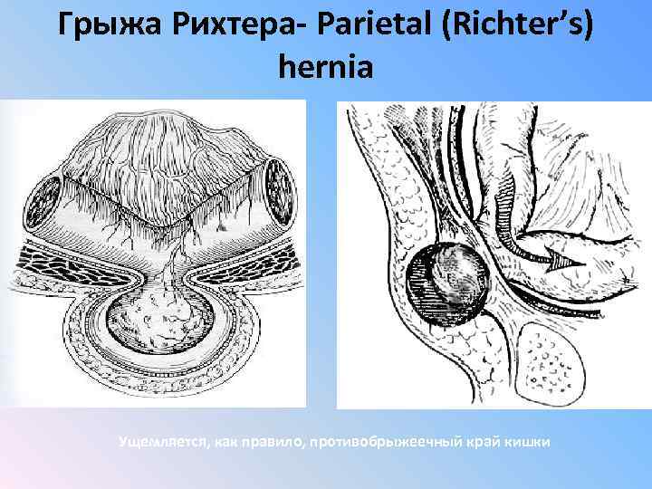 Грыжа Рихтера- Parietal (Richter’s) hernia Ущемляется, как правило, противобрыжеечный край кишки 