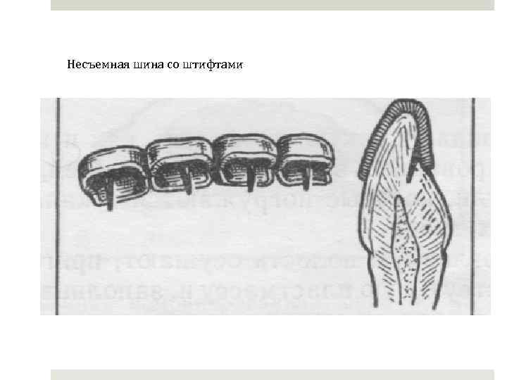 Несъемная шина со штифтами 