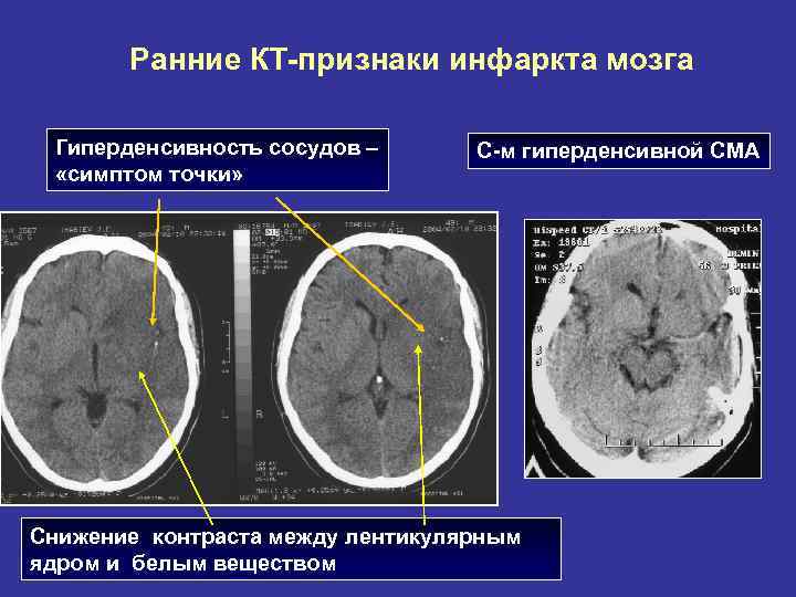 Ранние КТ-признаки инфаркта мозга Гиперденсивность сосудов – «симптом точки» С-м гиперденсивной СМА Снижение контраста