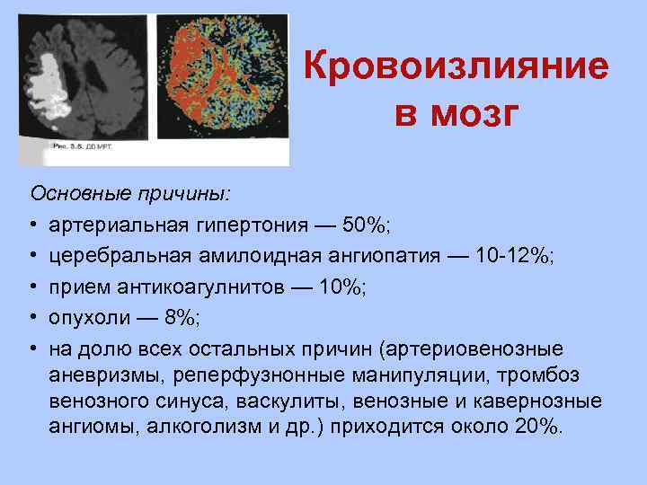 Кровоизлияние в мозг Основные причины: • артериальная гипертония — 50%; • церебральная амилоидная ангиопатия