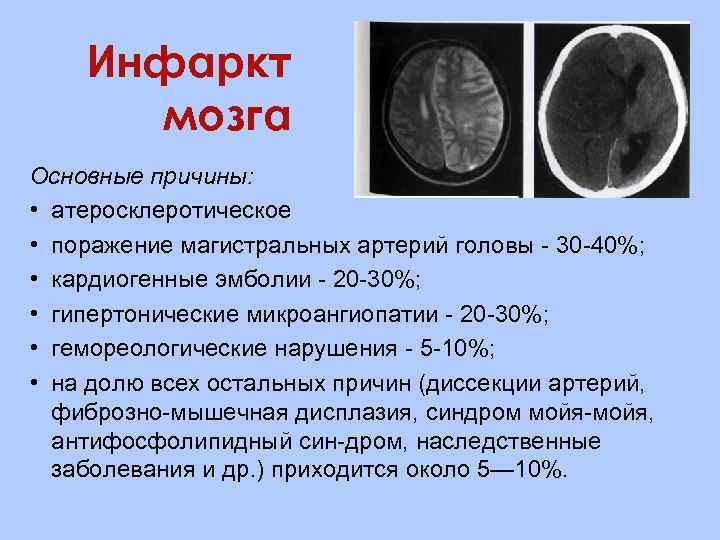 Инфаркт мозга Основные причины: • атеросклеротическое • поражение магистральных артерий головы 30 40%; •