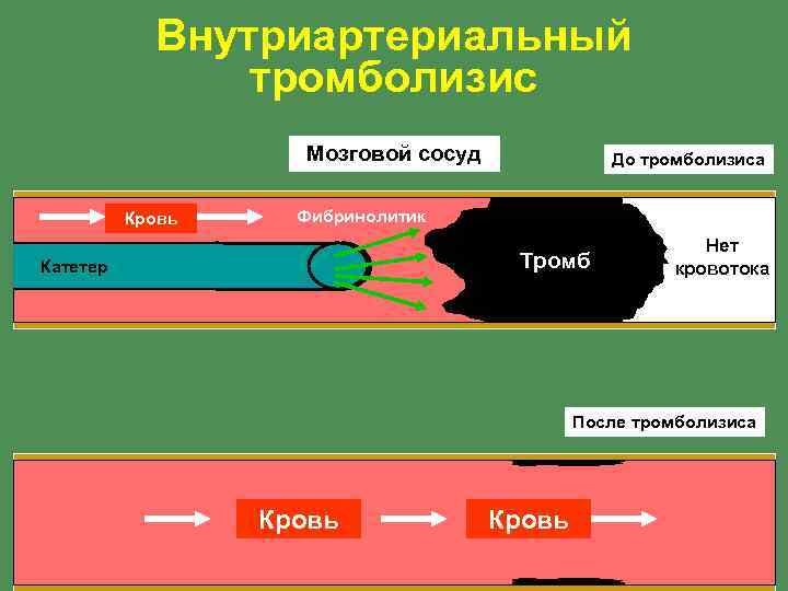 Внутриартериальный тромболизис Мозговой сосуд Кровь До тромболизиса Фибринолитик Тромб Катетер Нет кровотока После тромболизиса