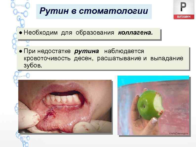 Рутин в стоматологии ● Необходим для образования коллагена. ● При недостатке рутина наблюдается кровоточивость