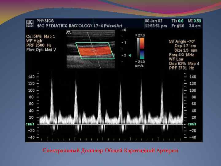 Спектральный Допплер Общей Каротидной Артерии 