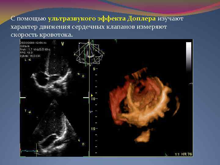 С помощью ультразвукого эффекта Доплера изучают характер движения сердечных клапанов измеряют скорость кровотока. 