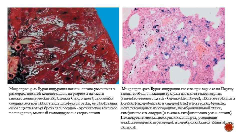 Макропрепарат. Бурая индурация легких: легкие увеличены в размерах, плотной консистенции, на разрезе в их