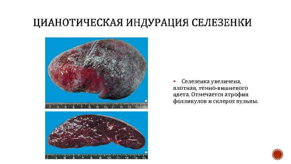 Селезенка увеличена, плотная, темно-вишневого цвета. Отмечается атрофия фолликулов и склероз пульпы. § 