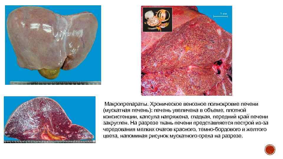  Макропрепараты. Хроническое венозное полнокровие печени (мускатная печень): печень увеличена в объеме, плотной консистенции,