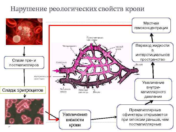 Нарушение реологических свойств крови Местная гемоконцентрация Переход жидкости в интерстициальное пространство Спазм пре- и