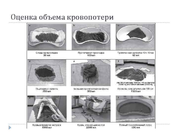 Оценка объема кровопотери 