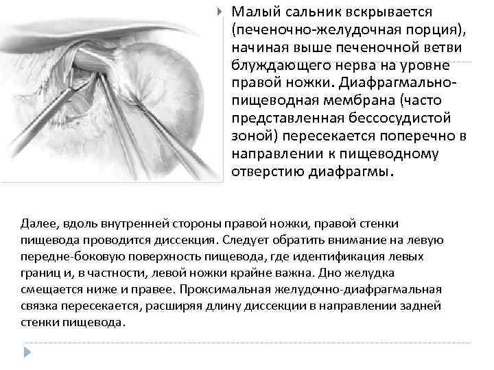  Малый сальник вскрывается (печеночно-желудочная порция), начиная выше печеночной ветви блуждающего нерва на уровне