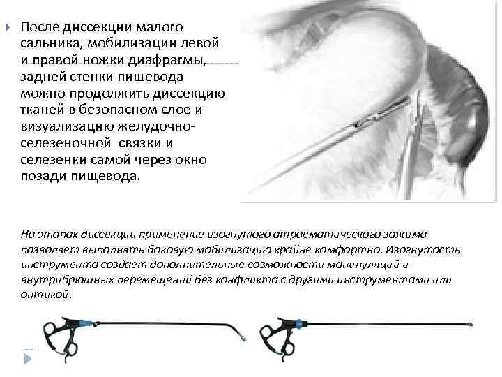  После диссекции малого сальника, мобилизации левой и правой ножки диафрагмы, задней стенки пищевода