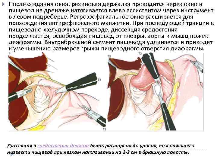  После создания окна, резиновая держалка проводится через окно и пищевод на дренаже натягивается